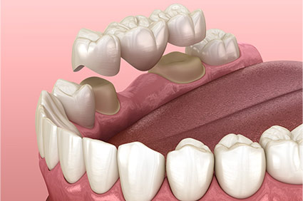 Diagram of dental bridge above 3