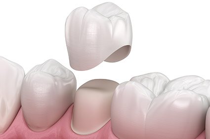 Diagram of dental crown put in place