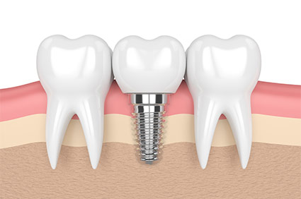 Diagram of dental implant with screw